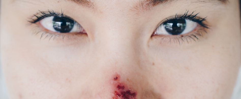 Nasenherpes: Wann zum Arzt und was hilft?